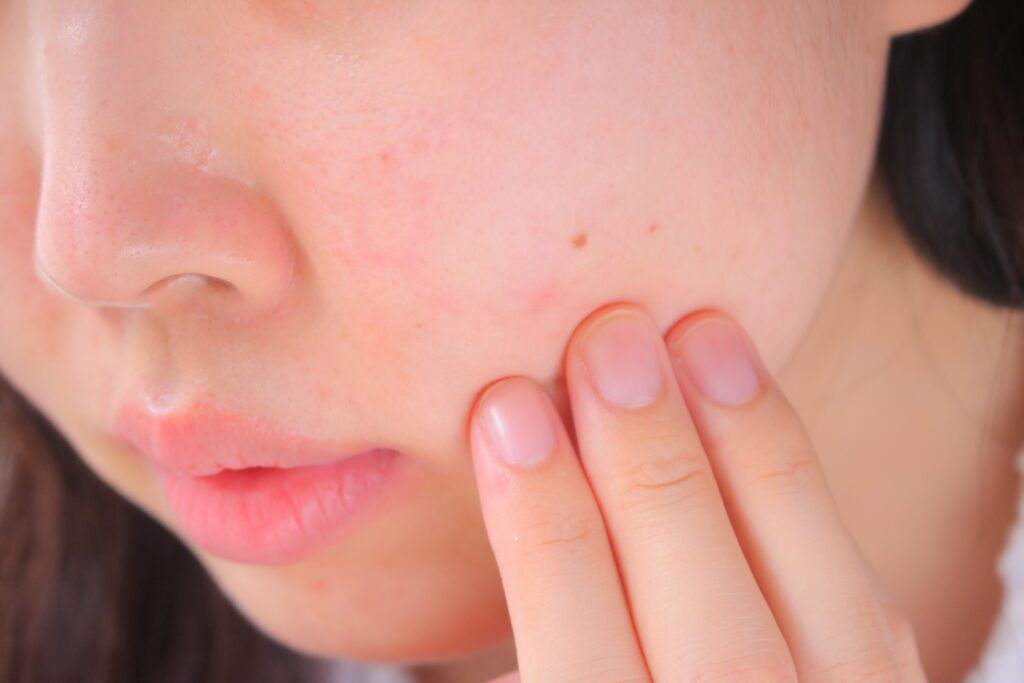 乾燥肌　女性　スキンケア